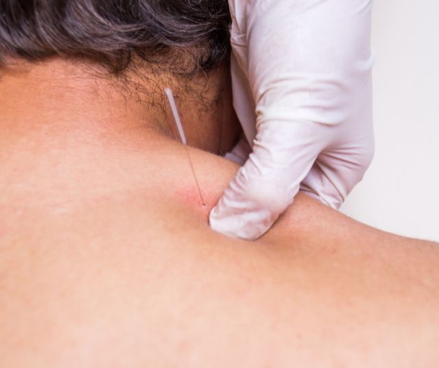 Man receiving dry needling treatment